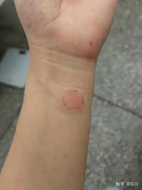 做完ppd48小时以后这样正常吗