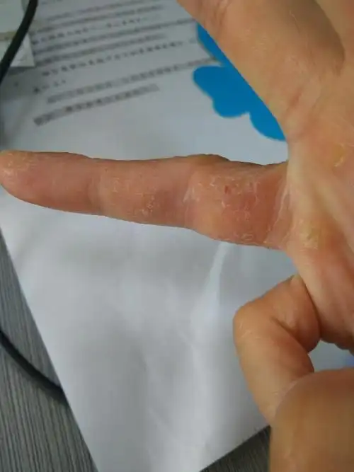 我这手去医院说是湿疹,问题是怎么治都不好,该怎么办呀.好苦恼