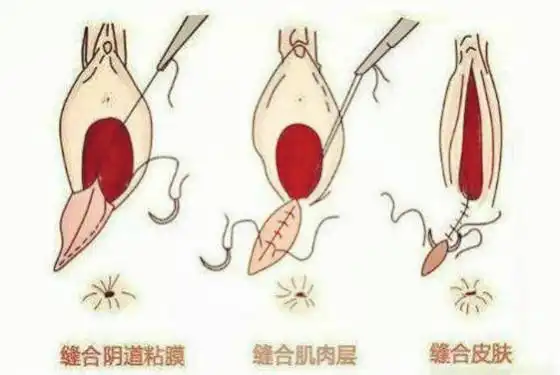 女人生小孩顺产缝针图看得我心里直打颤