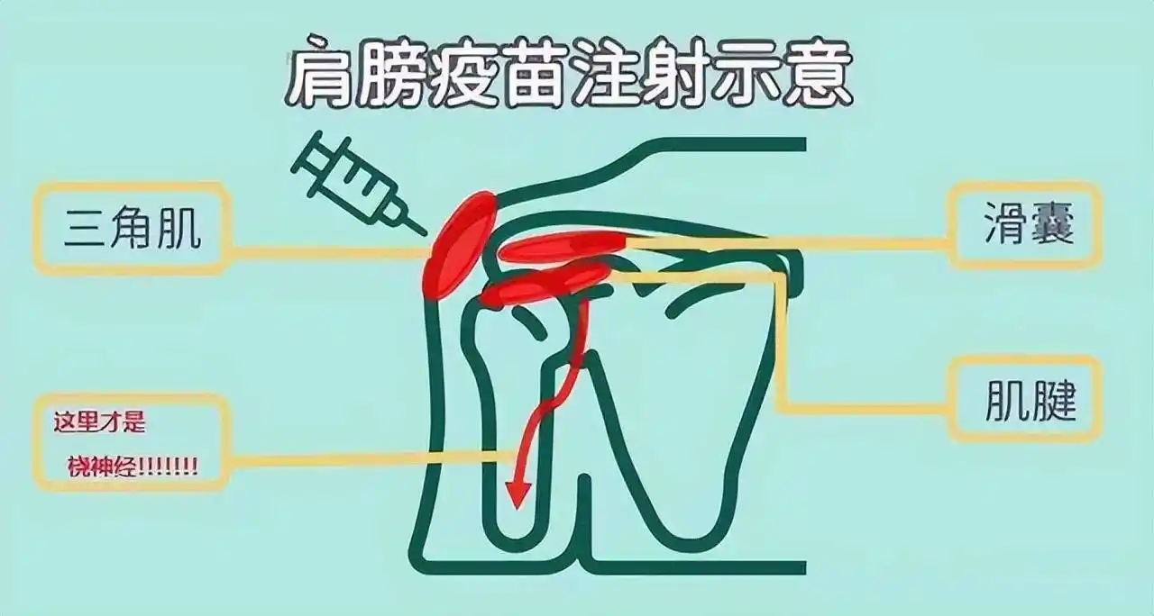 刺激肌肉和神经的成分,部分患者会因此出现手臂肌肉酸痛,注射部位疼痛