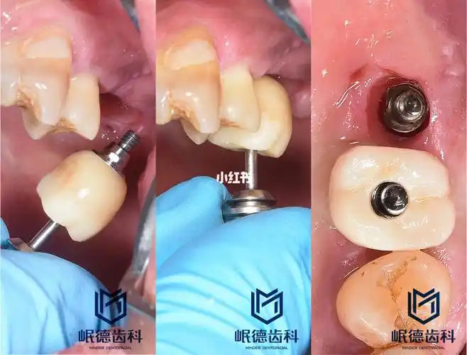 种植完牙三个月后戴牙冠,戴上以后当天就可以正常使用了.