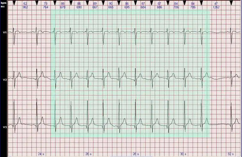 心电图病例分析加速的房性自主心律