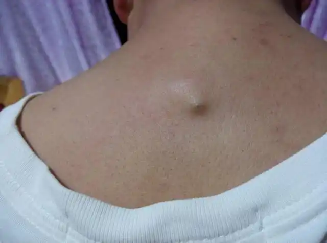 很多皮肤本来是中性的人皮肤变的爱出油,变成油性;2,后背黑头会越来越