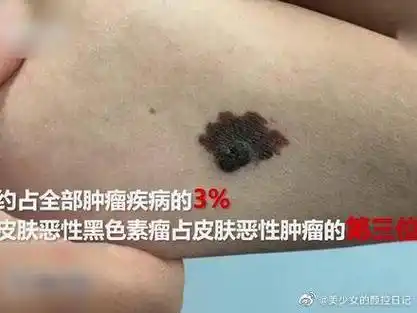 什么是黑色素瘤?