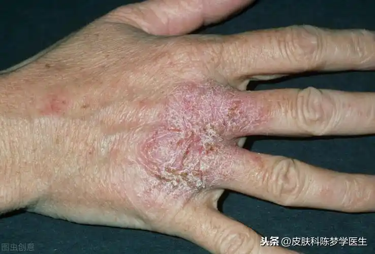 各种皮肤病图片大全8种常见皮肤病对应的外涂药膏