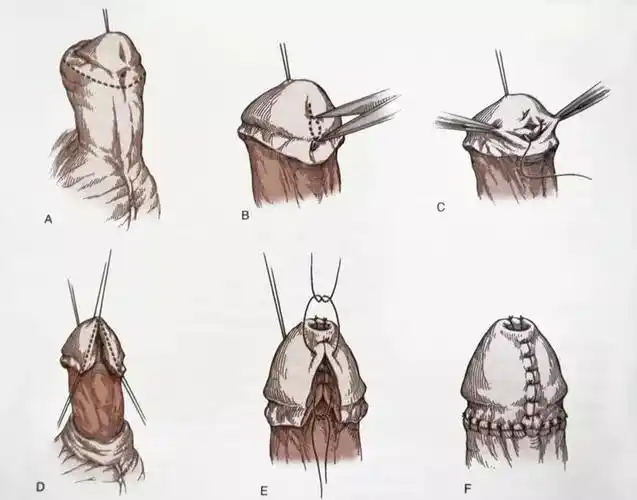 杭州禧月阁科普小儿尿道下裂