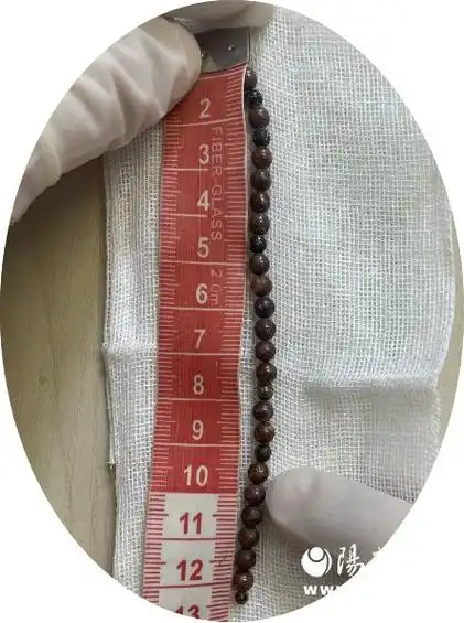 男子26颗磁力珠经尿道入膀胱 省第二人民医院微创技术帮取出|手术