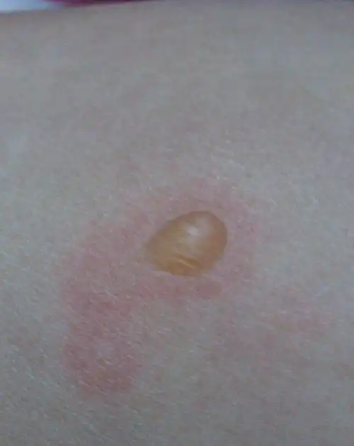 皮肤上长了一个水泡,各位神医帮忙看看.