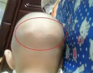 婴儿后脑勺太突出要怎么调整2