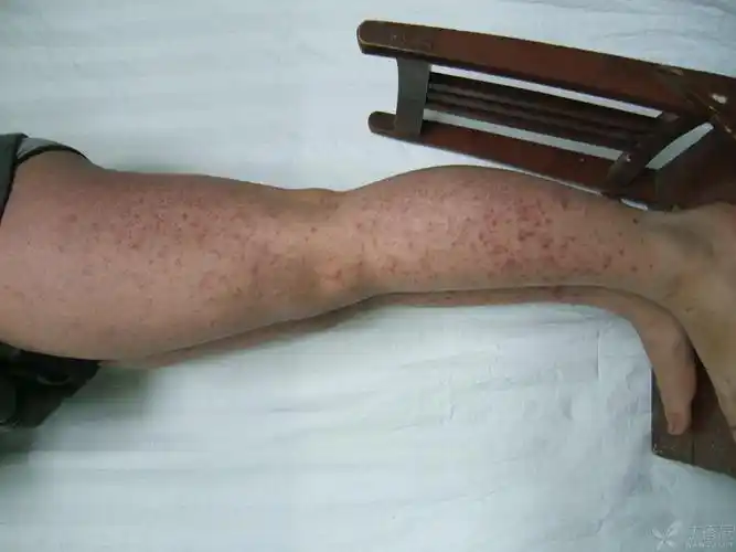 【病例讨论】变应性血管炎?紫癜?药疹? [病例帖]