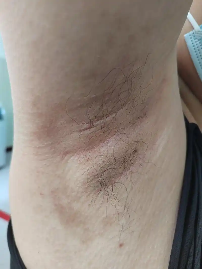 腋下瘙痒症状.#解决皮肤问题专注皮肤美容