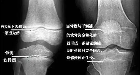 人体长高,依靠的是骨骺线,在骨骺与干骺端之间有一块软骨,软骨与骨垢