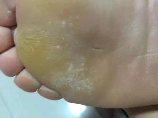 晚上刚泡完脚脚底出现了小白疙瘩到底是怎么啦,是脚气吗