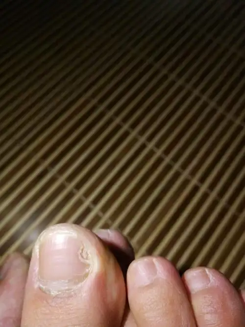 脚趾甲一直这样变空是什么病