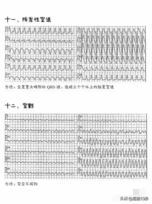 一图胜千言,一次性学会看21种心电图!