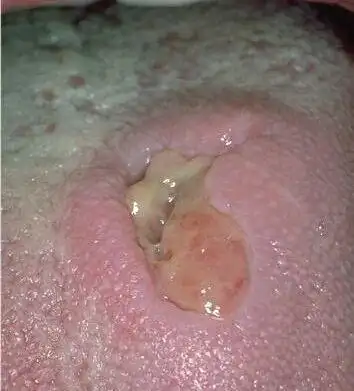舌头溃疡