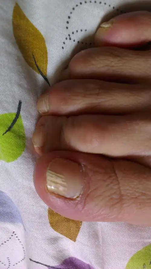 脚趾甲发白,有照片!需要好心的大夫帮助!亲戚说是心脏不好!