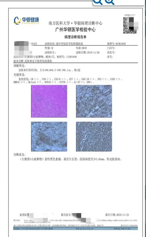 足趾结节性黑素瘤1例_黑色素瘤 - 好大夫在线