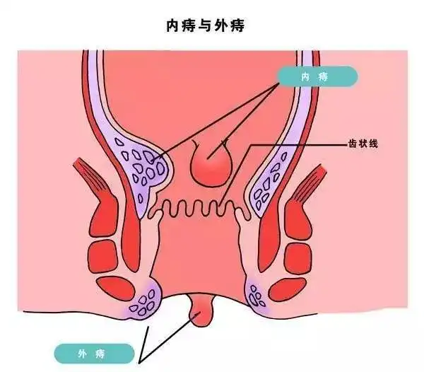 3,肛乳头肥大脱出脱出物呈灰白色或淡黄色,其上的短蒂如鼓槌状,质硬