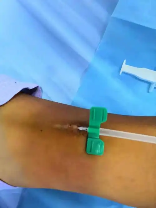 我院血透中心成功开展最新内瘘穿刺法——钝针"扣眼穿刺法"