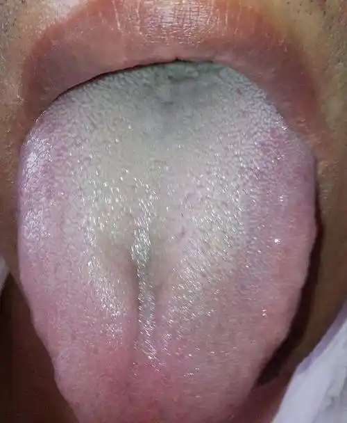 舌头白色舌苔厚白(舌头白色舌苔厚白,舌头中间痛)