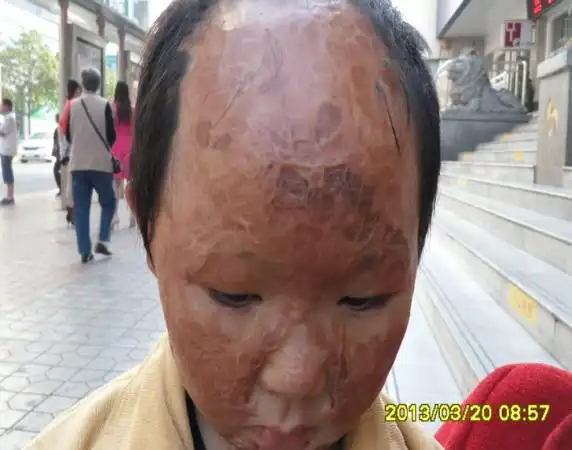 谁知道这样的烧伤恢复性的植皮在成都需要多少钱?