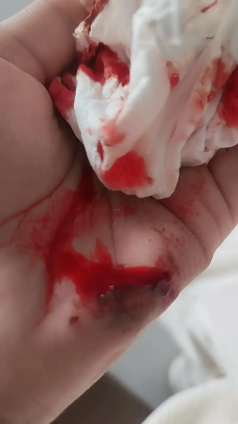 我搞到手疼得我冒汗我没哭 血不停的流我没哭 医生给我打针