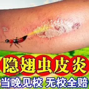隐翅虫咬伤药膏皮炎臭虫红火蚂蚁叮咬伤水泡糜烂瘙痒止痒消肿祛疤