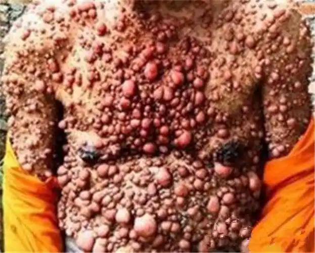 手臂皮下脂肪瘤图片