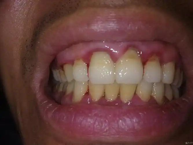 上下门牙牙龈红肿出血半年多求怎么治疗有实拍图片