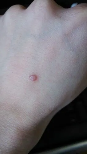 (图)手背上长个小疙瘩,1年多了,也不痛不痒