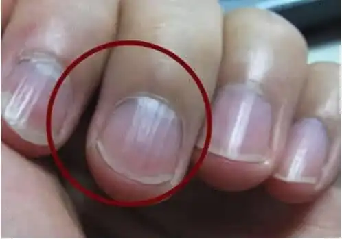 男性肾不好,指甲会出现3个"异常",别硬拖到"尿毒症"晚期!