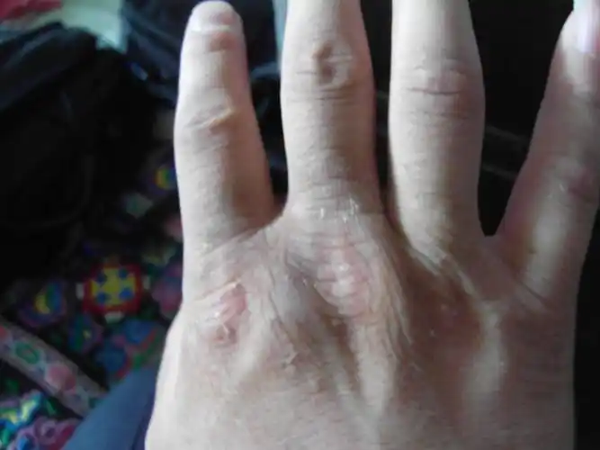 手背脱皮,怎么办?