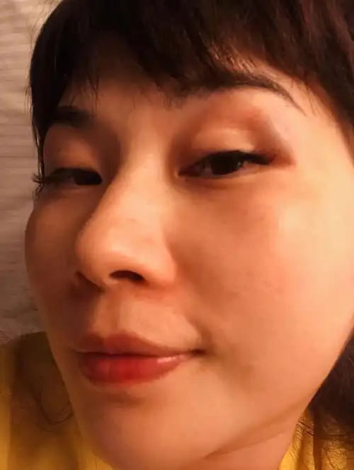 亲身科普淤青的过程