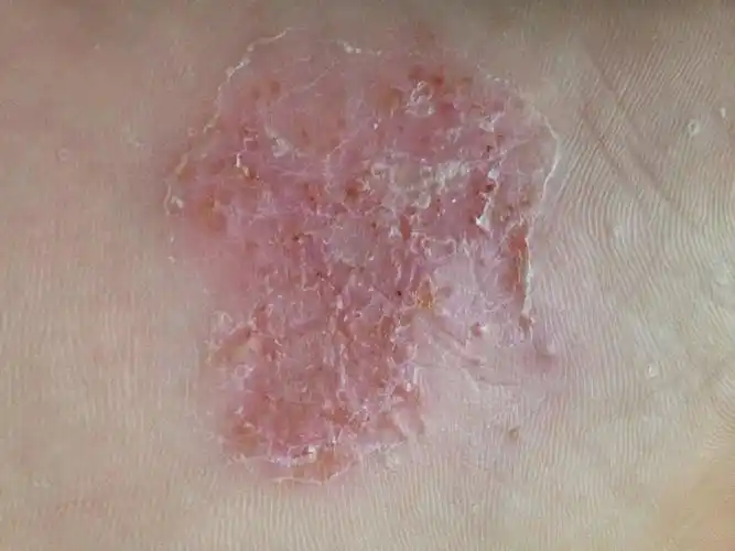 我男朋友的脚底板就烂了一快 最开始不痛的 有的时候走路会痛 有的