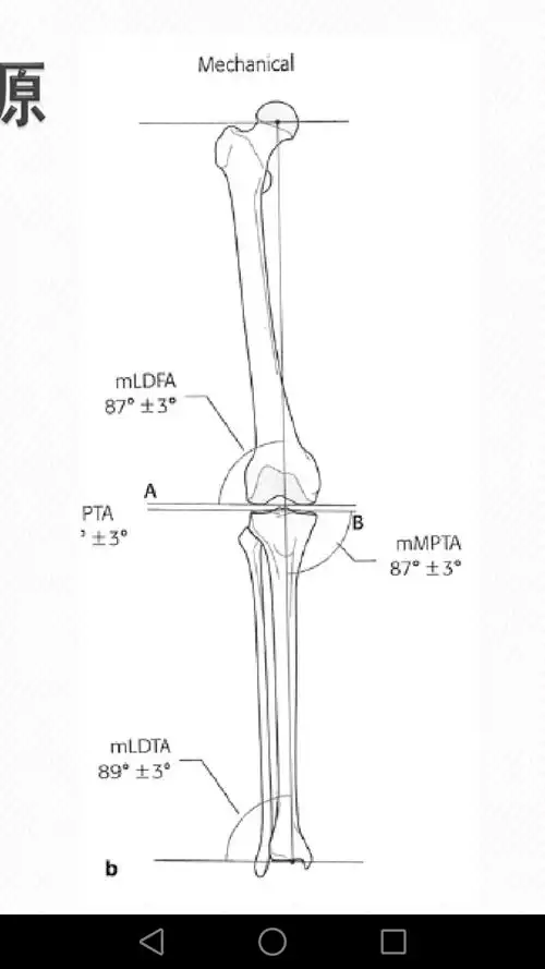 正常的下肢关节力线以及角度这个患者的胫骨上端内侧角小,导致膝关节