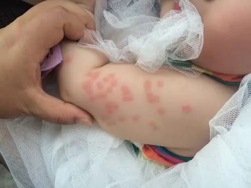 宝宝8个月,胳膊,大腿,脑后突然出了很多这样的红疙瘩,这是怎么回事啊