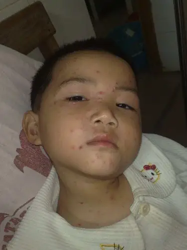 小孩水痘症状图片62