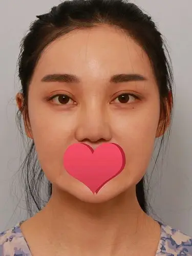 之前的眼睛眼尾上翘看着眼睛有点狭小,有点阴险的感觉_圈子-新氧美容