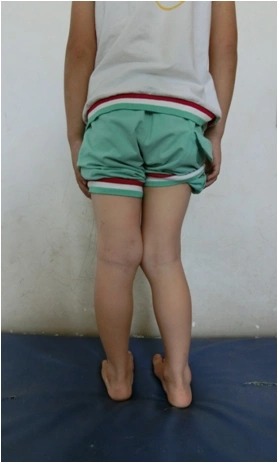 (6岁男孩,1年前膝关节骨折,现右膝外翻畸形)(术后1年畸形矫正)