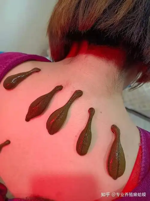 水蛭吸血疗法的功效与作用原理水蛭吸血对人体有害吗水蛭吸血可靠吗