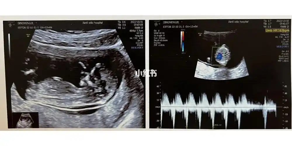 nt检查宝宝很配合但数值20mm