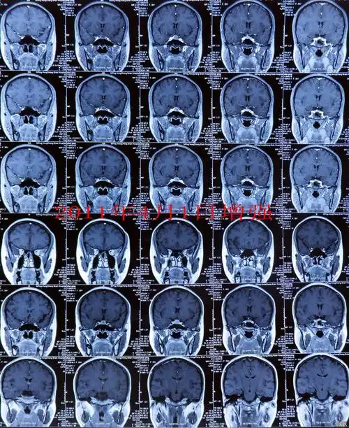 垂体病变mri讨论