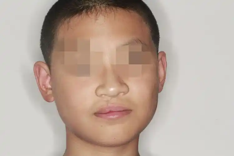 唇裂术后红唇功能性修复原创