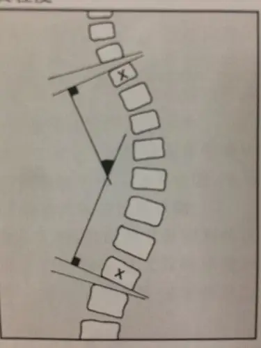 侧弯不超过25度-30度,通常不考虑矫正.