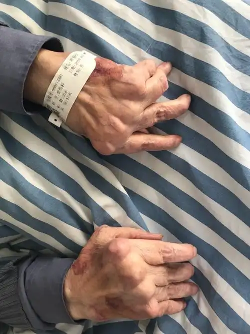 严重的类风湿关节炎晚期