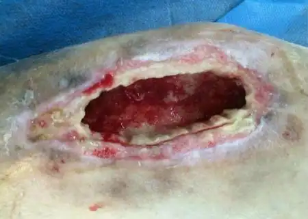 化脓性骨髓炎的诊断依据有哪些_石家庄天济医院