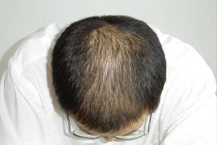 60岁之后,头发少的人或更健康?一文了解