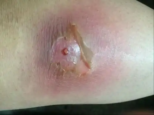 从你的图片上看,这个是火疖子.等白尖出来就好了.