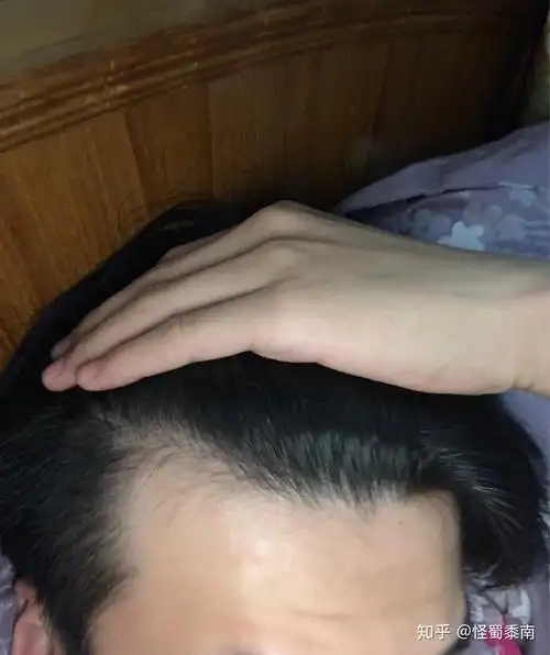 鬓角比以前高了 这样是属于脱发吗